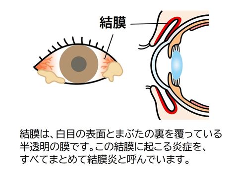 慢性結膜炎|結膜炎の症状は？原因や治るまでの期間、治療方法に。